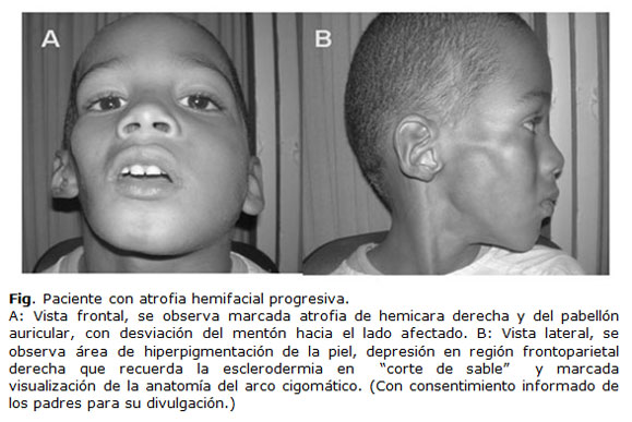 Atrofia hemifacial progresiva o Síndrome Parry Romberg asociado a ...